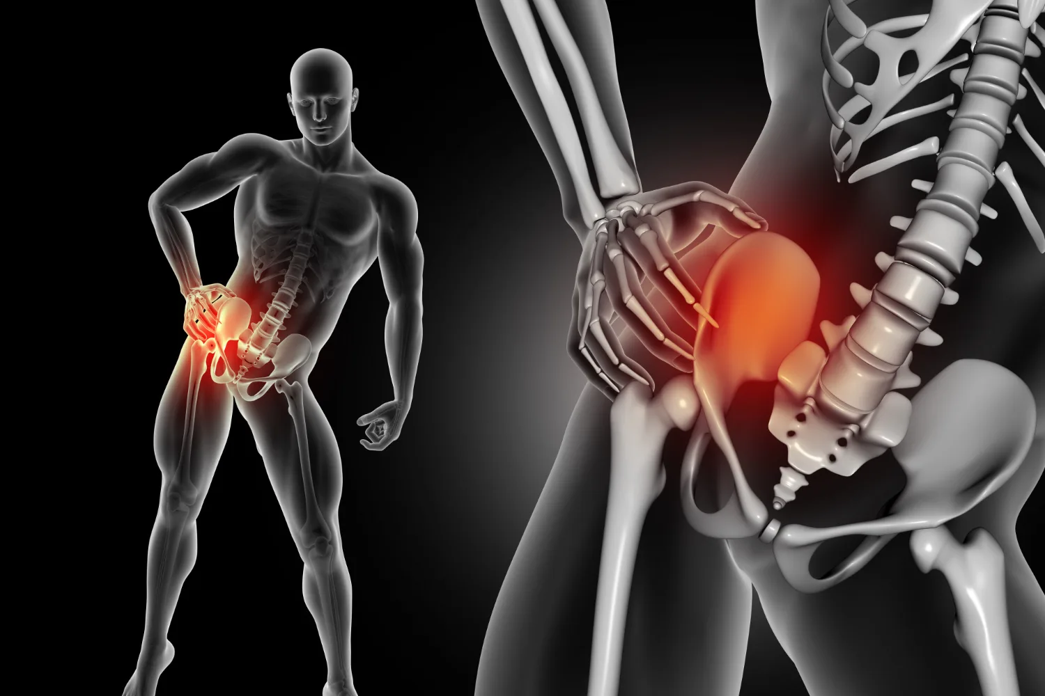 Tratamiento de lesiones de cadera en Cuautitlán Izcalli y Texcoco: Soluciones avanzadas en Ortopedia